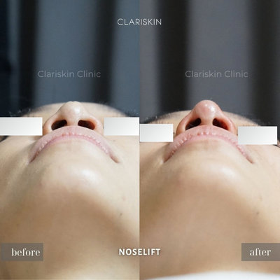 Before - Noselift