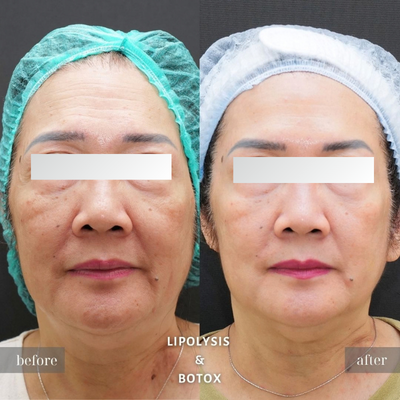 Before - BOTOX
