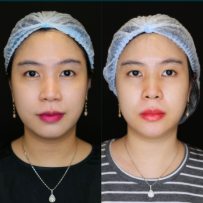 Before - ACNE SCAR