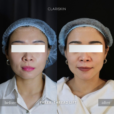 Before - Filler & Threadlift