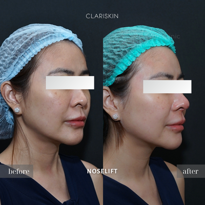 Before - Noselift