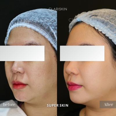 Before - SuperSkin