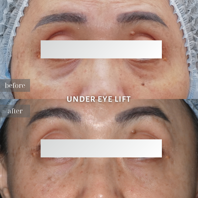 Before - Under Eye Lift