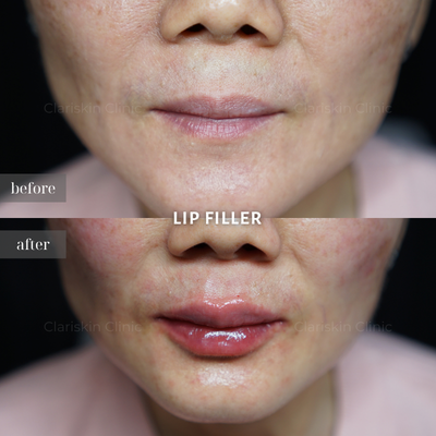 Before - Lip Filler